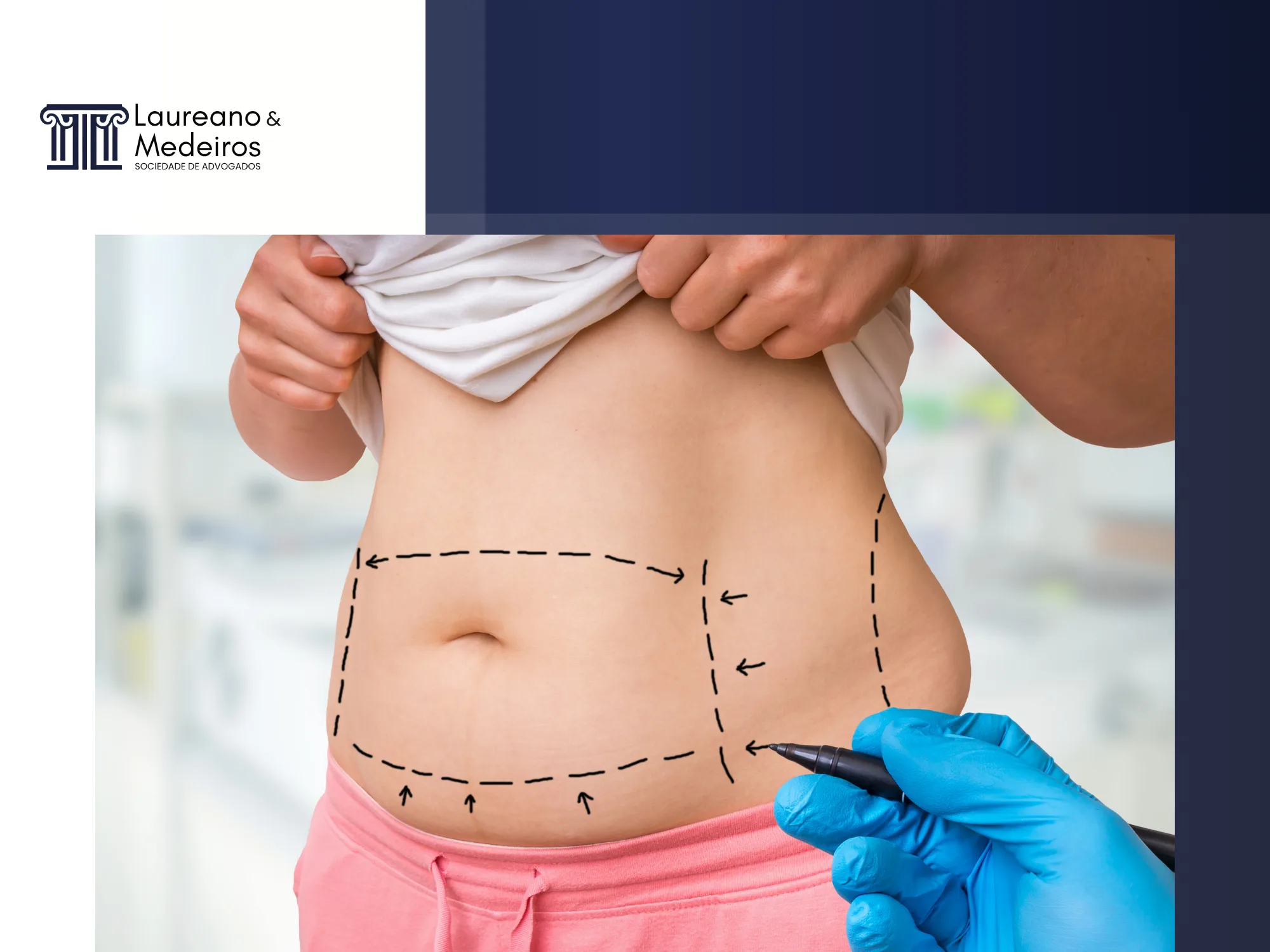 Cirurgia Reparadora Pós-Bariátrica: O Guia Completo de Direitos e Como Conseguir Cobertura pelo Plano de Saúde